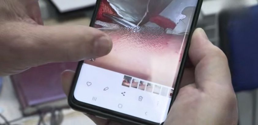 Редкий случай: В Краснодарском крае у девочки обнаружили паразита в теле